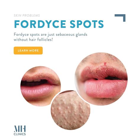 Fordyce spots: Quick and Informative guidance